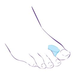 СТ-51 Приспособление корригирующее (силиконовая межпальцевая перегородка увеличенного размера)